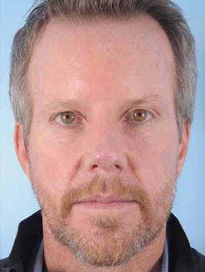 Facial Resurfacing Before & After Gallery - Patient 185325 - Image 2