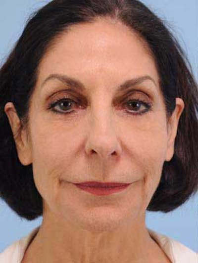 Facial Resurfacing Before & After Gallery - Patient 457915 - Image 1