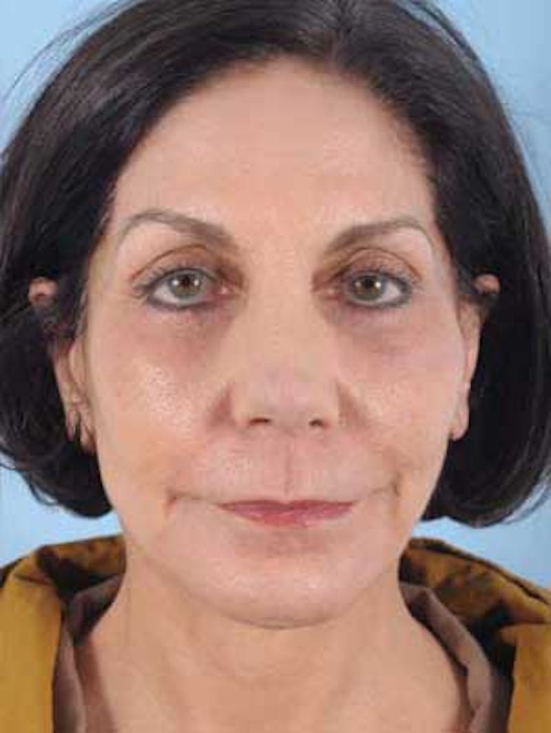 Facial Resurfacing Before & After Gallery - Patient 457915 - Image 2