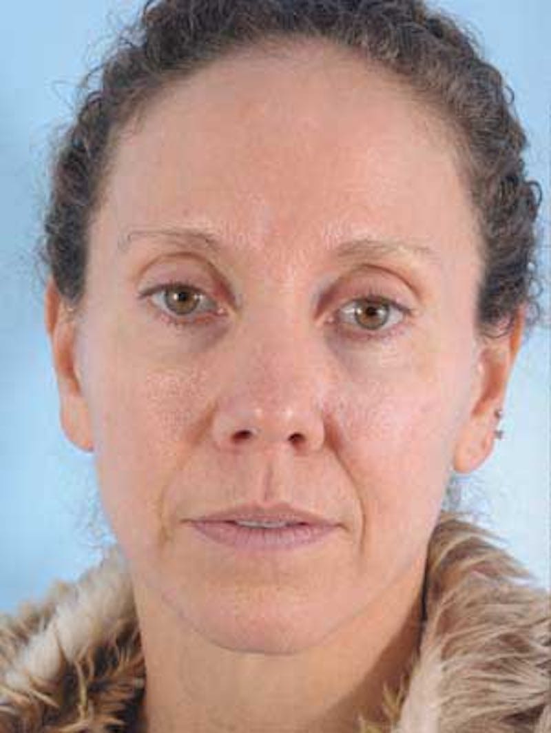 Facial Resurfacing Before & After Gallery - Patient 407548 - Image 1