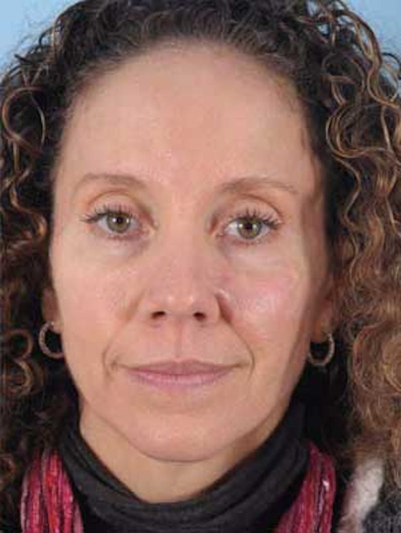 Facial Resurfacing Before & After Gallery - Patient 407548 - Image 2
