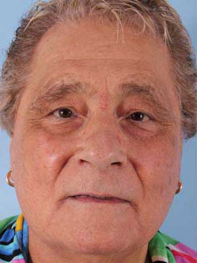 Facial Resurfacing Before & After Gallery - Patient 130232 - Image 1