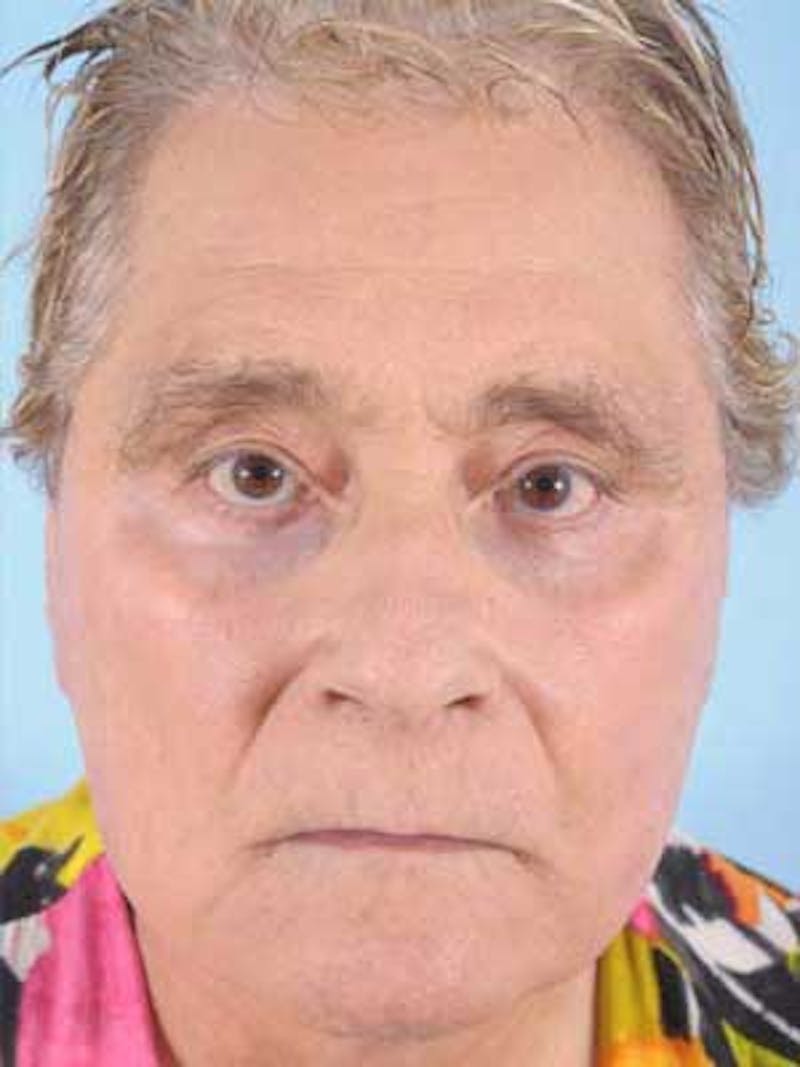 Facial Resurfacing Before & After Gallery - Patient 130232 - Image 2