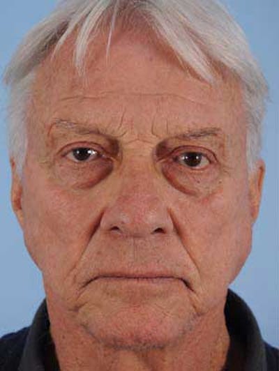 Facial Resurfacing Before & After Gallery - Patient 241089 - Image 1