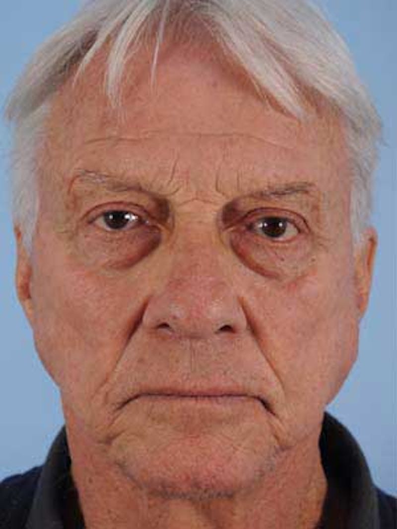 Facial Resurfacing Before & After Gallery - Patient 241089 - Image 1