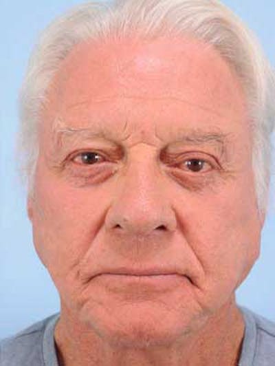 Facial Resurfacing Before & After Gallery - Patient 241089 - Image 2