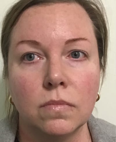 IPL Photofacial Before & After Gallery - Patient 375264 - Image 1