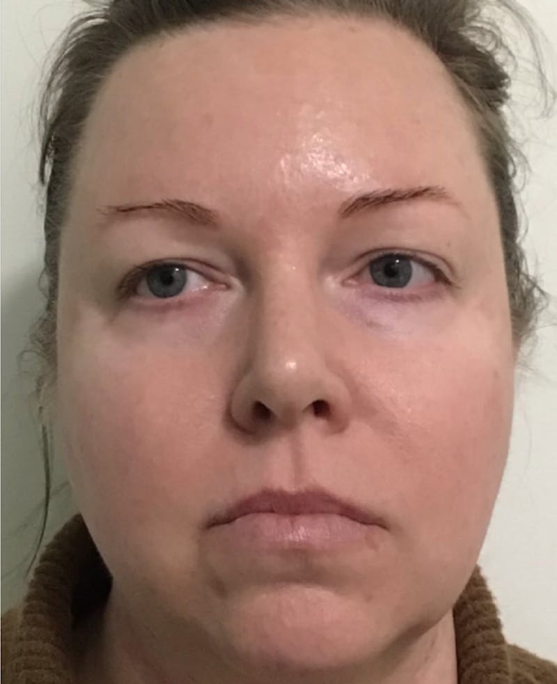 IPL Photofacial Before & After Gallery - Patient 375264 - Image 2