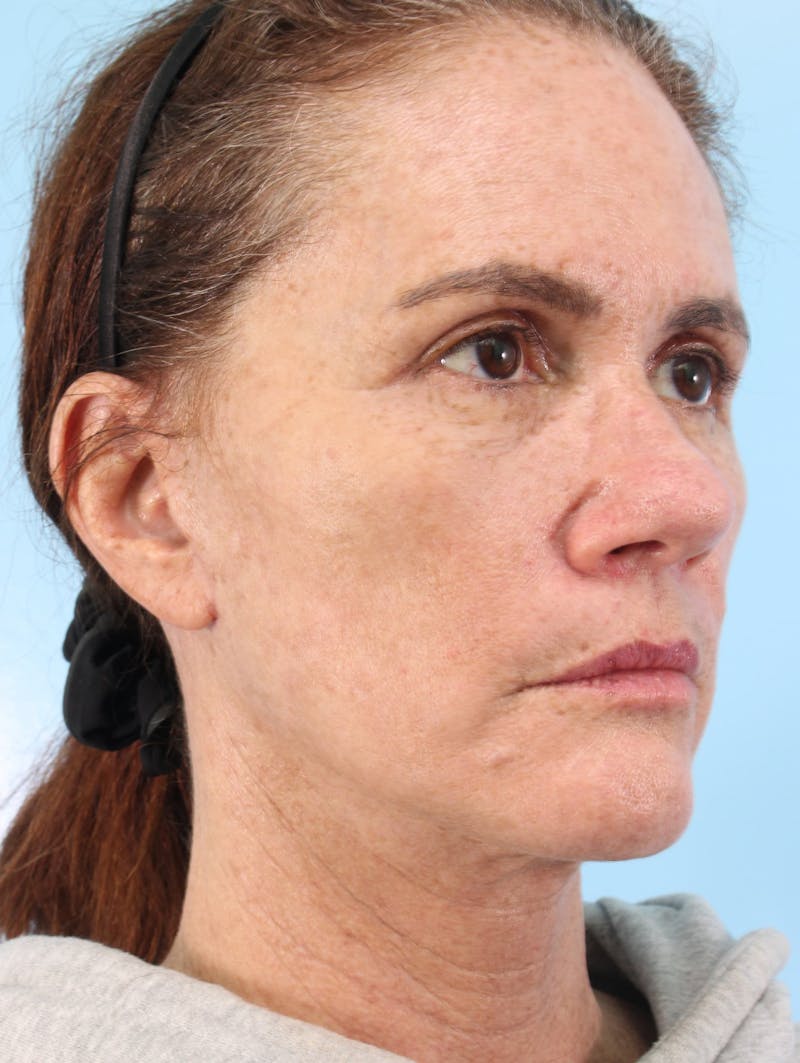 IPL Photofacial Before & After Gallery - Patient 200097 - Image 2