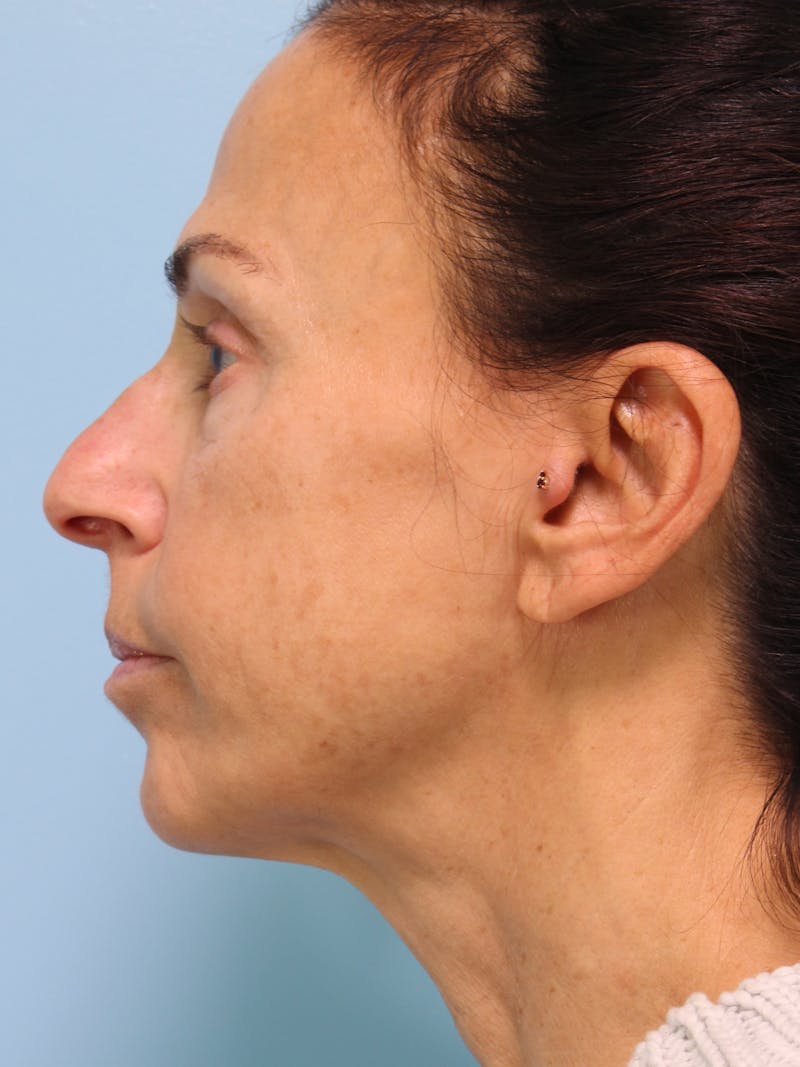 Thread Lift Before & After Gallery - Patient 160139 - Image 3