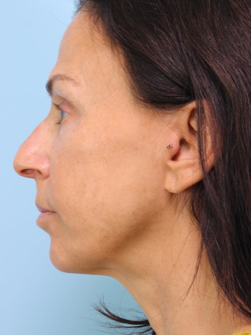 Thread Lift Before & After Gallery - Patient 160139 - Image 4