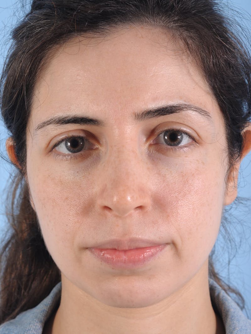 IPL Photofacial Before & After Gallery - Patient 183965 - Image 2
