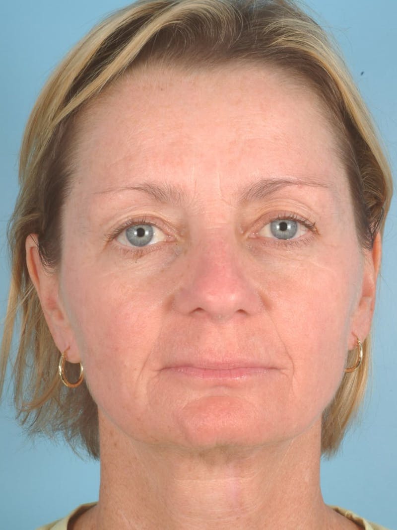 IPL Photofacial Before & After Gallery - Patient 229701 - Image 2