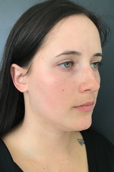 IPL Photofacial Before & After Gallery - Patient 357975 - Image 1