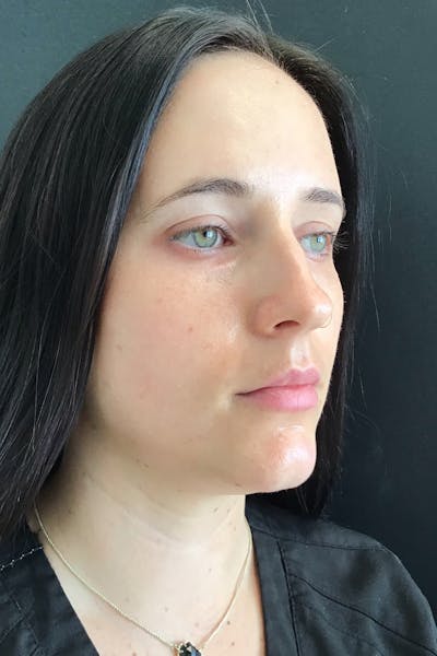 IPL Photofacial Before & After Gallery - Patient 357975 - Image 2
