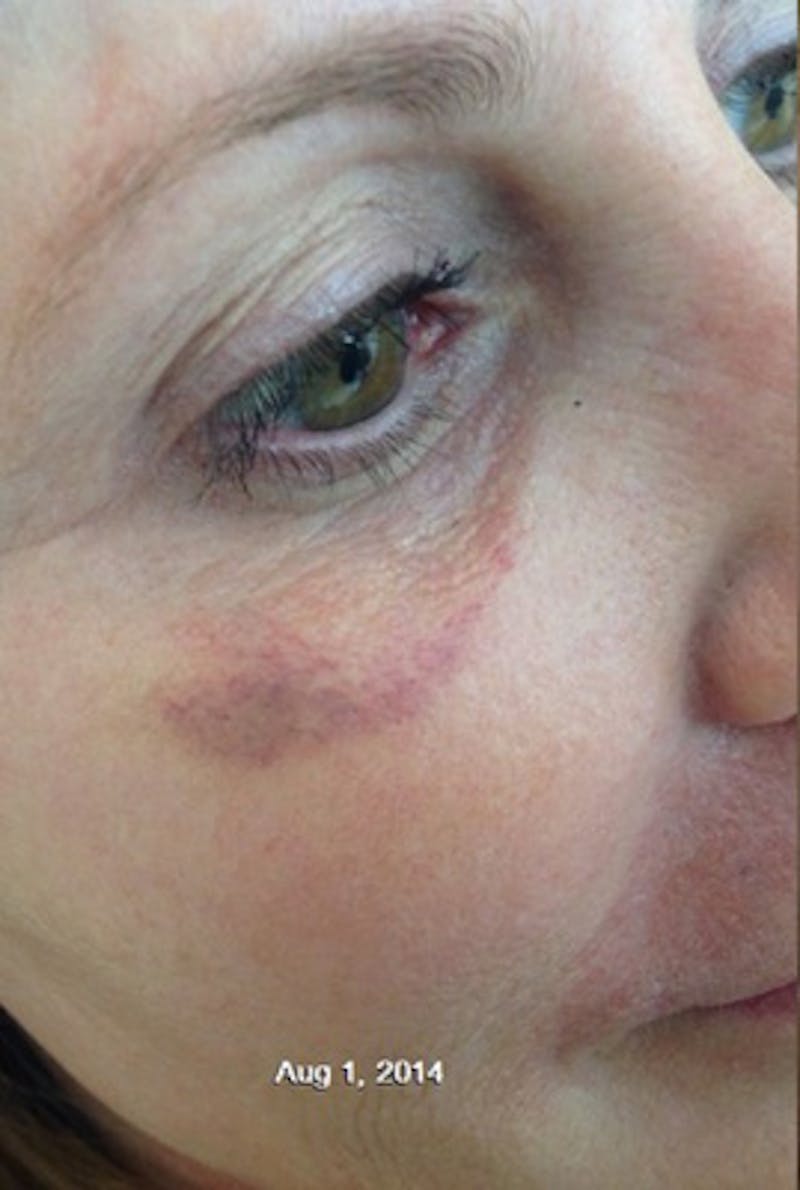 IPL Photofacial Before & After Gallery - Patient 298789 - Image 1