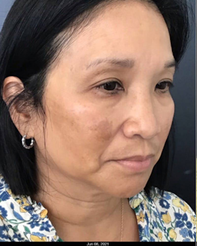 IPL Photofacial Before & After Gallery - Patient 337082 - Image 1
