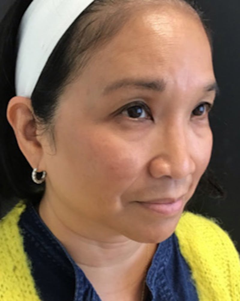 IPL Photofacial Before & After Gallery - Patient 337082 - Image 2