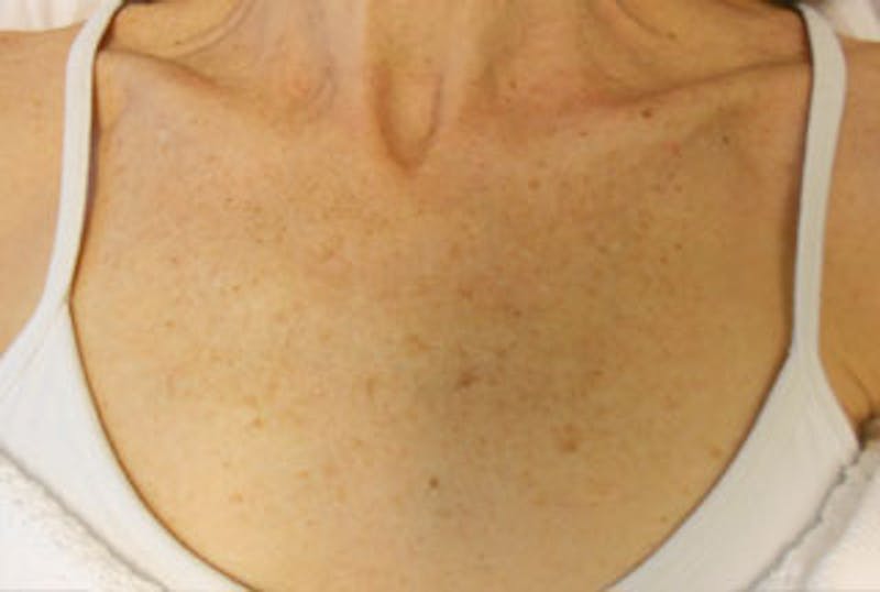IPL Photofacial Before & After Gallery - Patient 382756 - Image 1