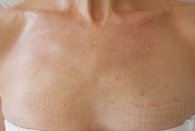 IPL Photofacial Before & After Gallery - Patient 382756 - Image 2