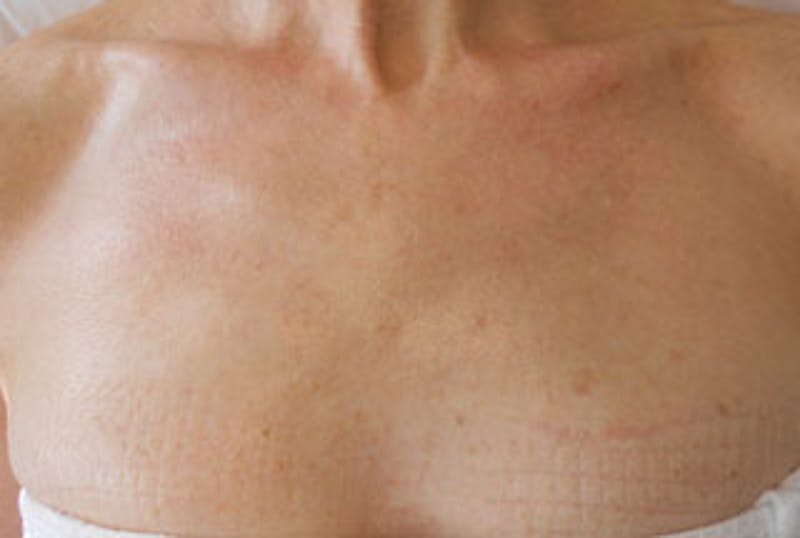 IPL Photofacial Before & After Gallery - Patient 382756 - Image 2