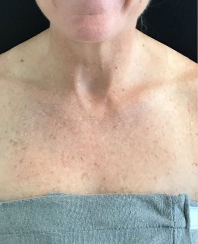 IPL Photofacial Before & After Gallery - Patient 270769 - Image 1