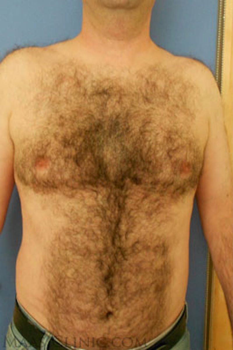 Laser Hair Removal Before & After Gallery - Patient 153521 - Image 1