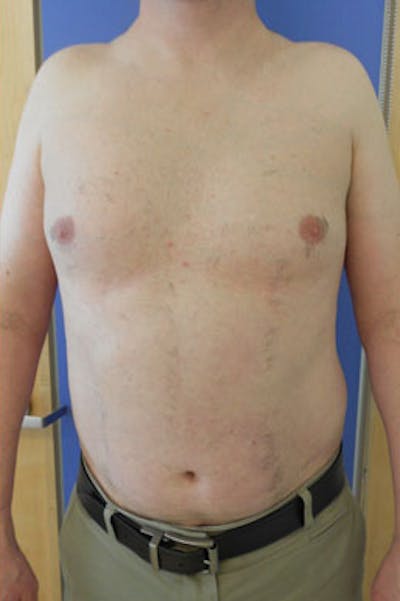 Laser Hair Removal Before & After Gallery - Patient 153521 - Image 2