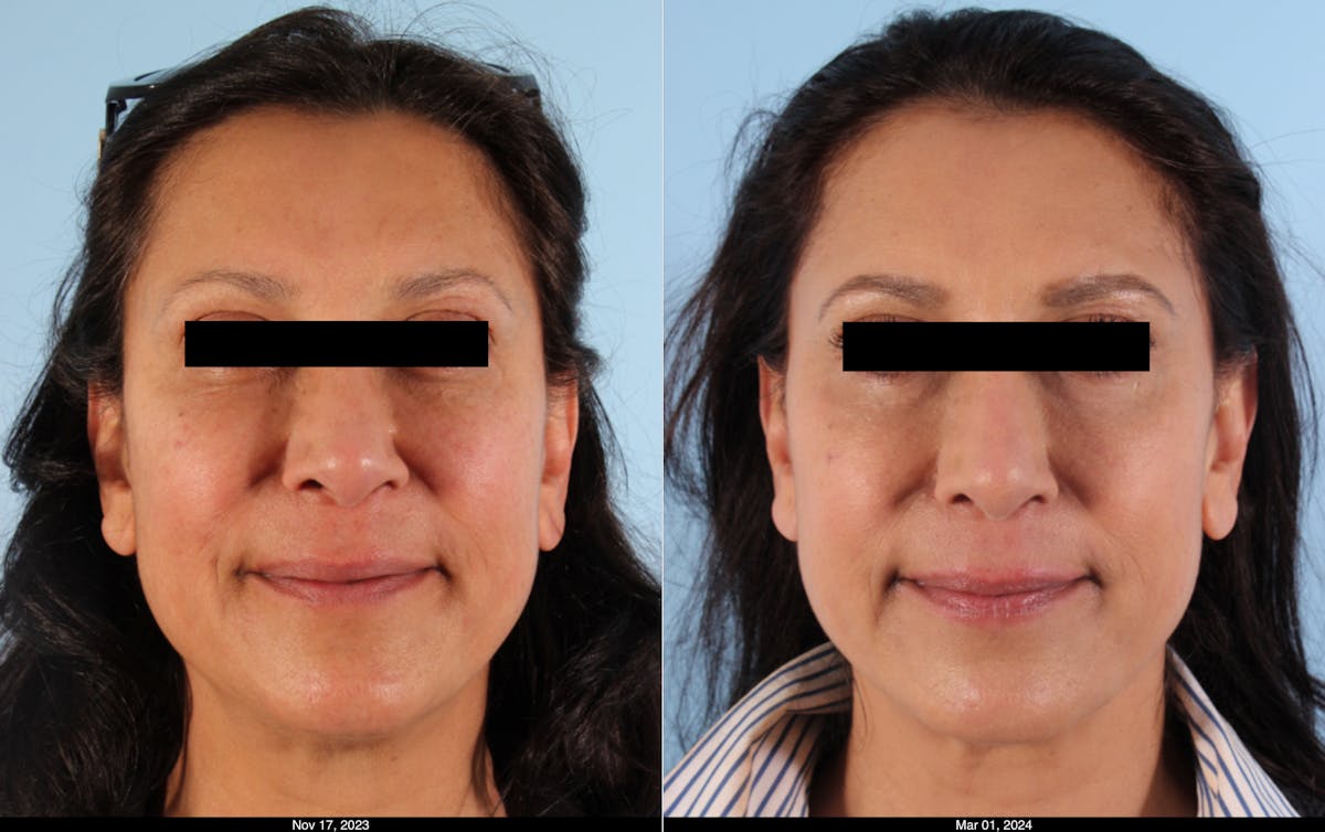 Scarlet RF Microneedling Before & After Gallery - Patient 354715 - Image 1