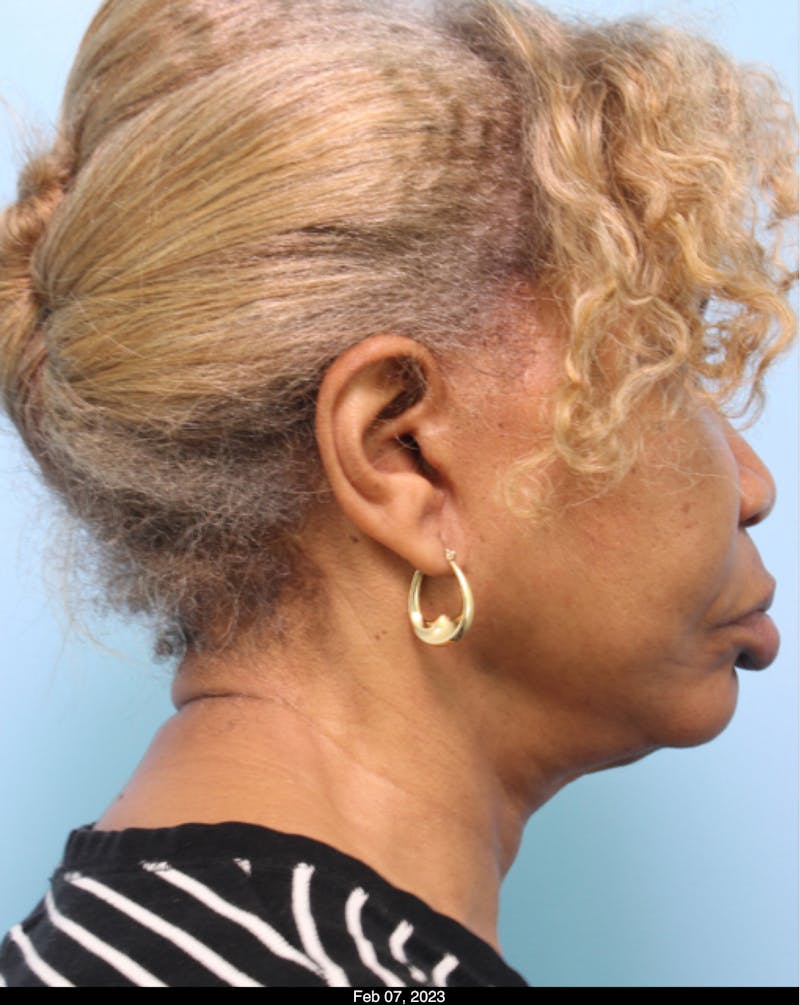 Scarlet RF Microneedling Before & After Gallery - Patient 667501 - Image 1