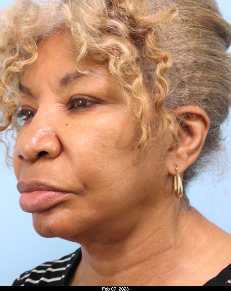 Scarlet RF Microneedling Before & After Gallery - Patient 667501 - Image 5