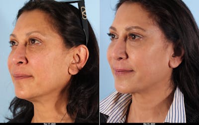 Scarlet RF Microneedling Before & After Gallery - Patient 321902 - Image 1