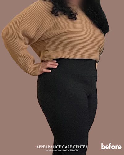 GLP-1 Weight Loss Before & After Gallery - Patient 164594 - Image 1