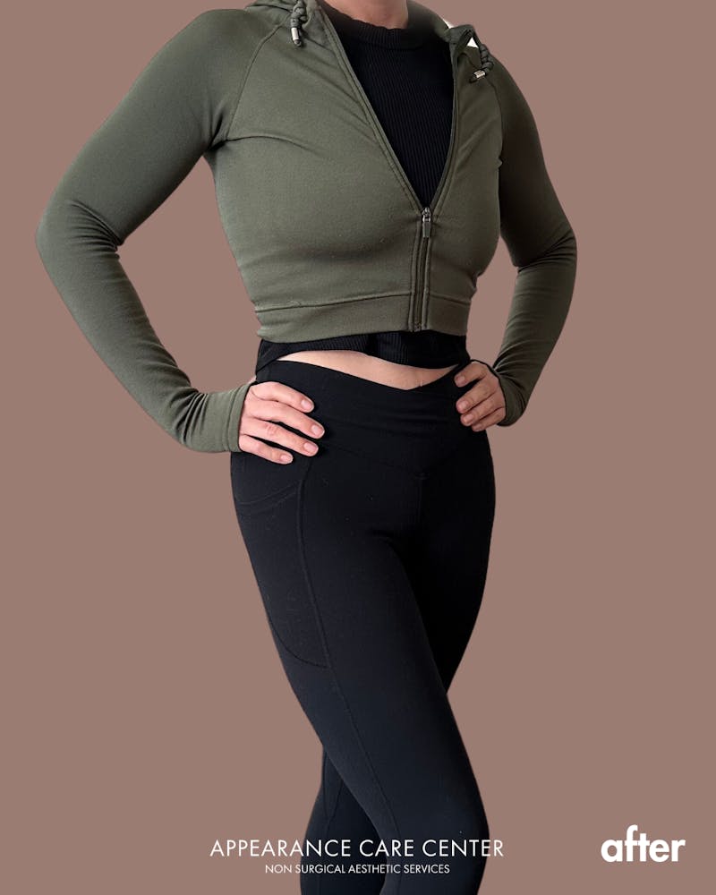 GLP-1 Weight Loss Before & After Gallery - Patient 164594 - Image 2