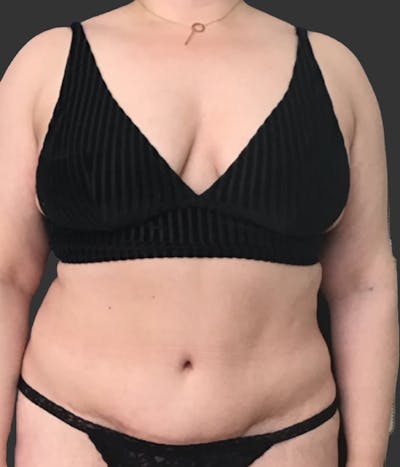 GLP-1 Weight Loss Before & After Gallery - Patient 351479 - Image 1