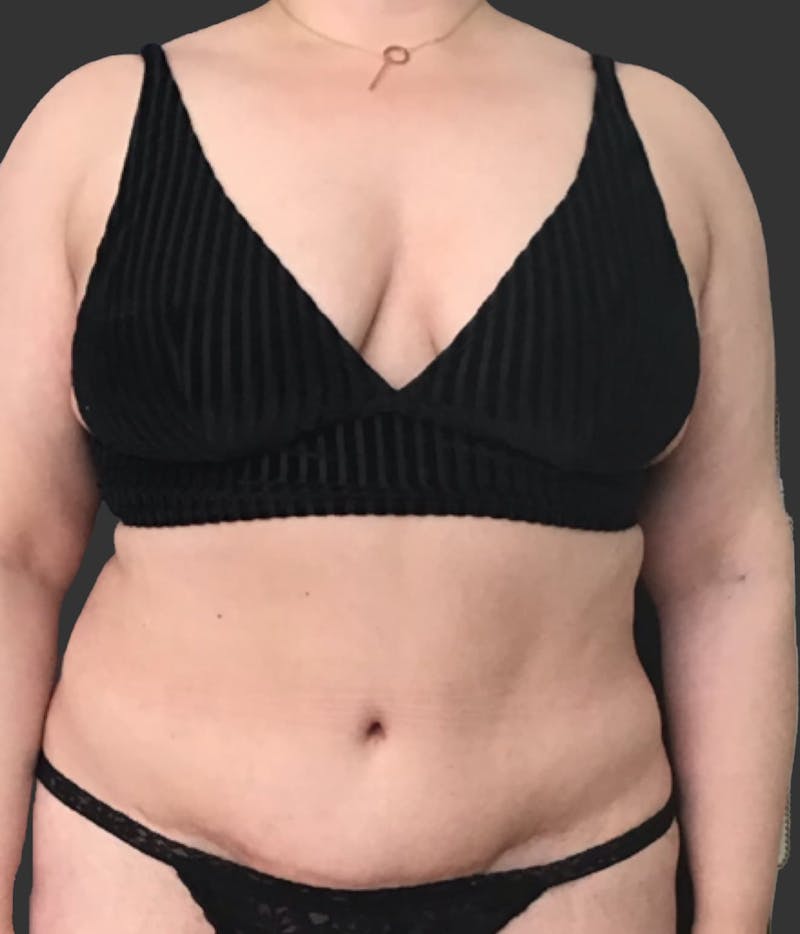 GLP-1 Weight Loss Before & After Gallery - Patient 351479 - Image 1