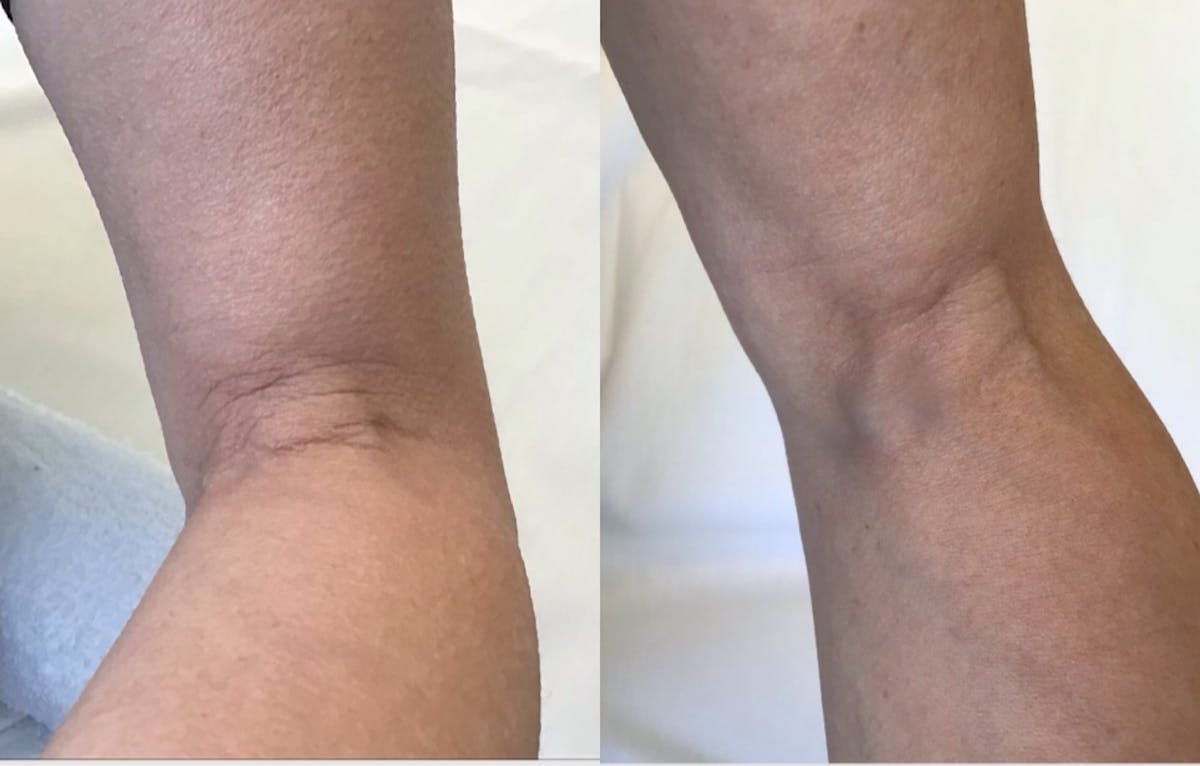 Sofwave Before & After Gallery - Patient 302572 - Image 1