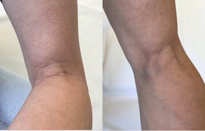 Sofwave Before & After Gallery - Patient 302572 - Image 1