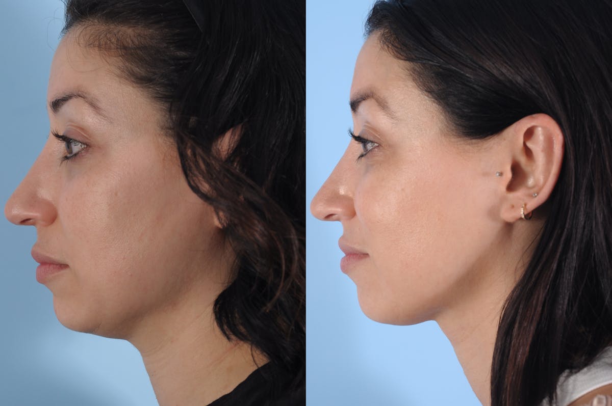 Sofwave Before & After Gallery - Patient 250908 - Image 2