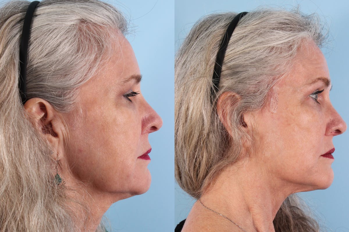 Thread Lift Before & After Gallery - Patient 400135 - Image 2