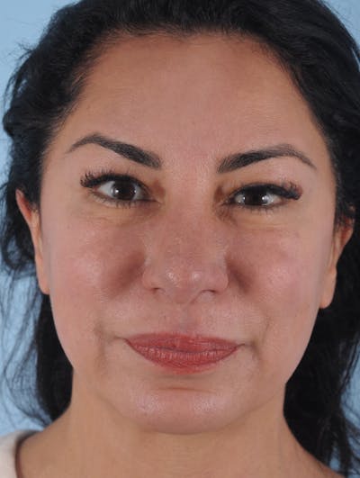 Thread Lift Before & After Gallery - Patient 311629 - Image 1