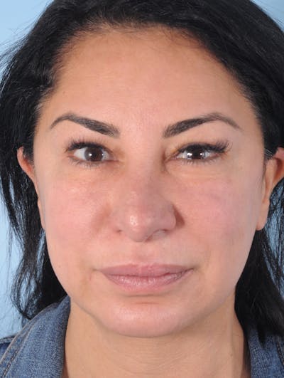 Thread Lift Before & After Gallery - Patient 311629 - Image 2