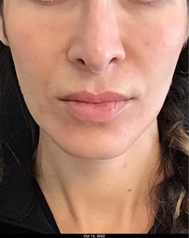 Thread Lift Before & After Gallery - Patient 858943 - Image 1