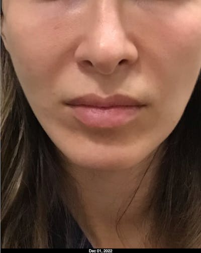 Thread Lift Before & After Gallery - Patient 858943 - Image 2