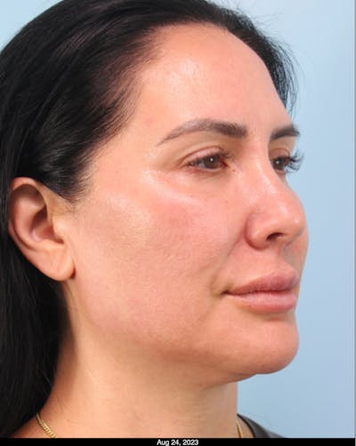 Thread Lift Before & After Gallery - Patient 153056 - Image 1