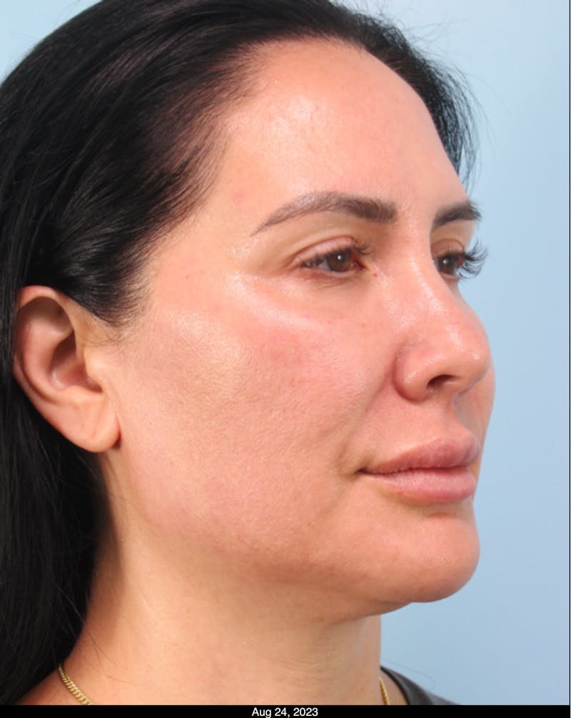 Thread Lift Before & After Gallery - Patient 153056 - Image 1