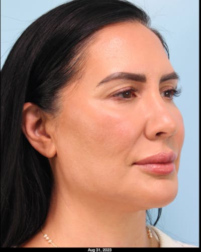 Thread Lift Before & After Gallery - Patient 153056 - Image 2