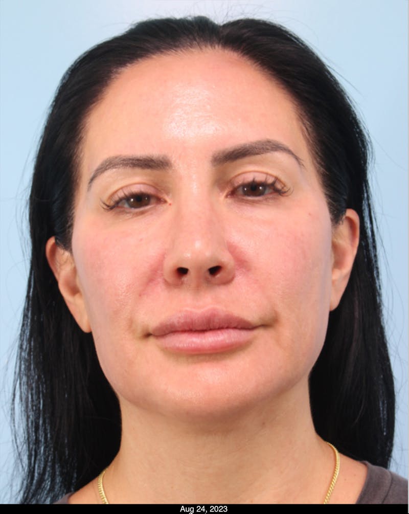 Thread Lift Before & After Gallery - Patient 153056 - Image 3