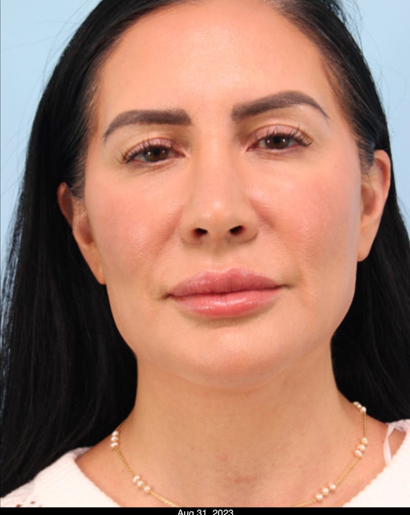 Thread Lift Before & After Gallery - Patient 153056 - Image 4