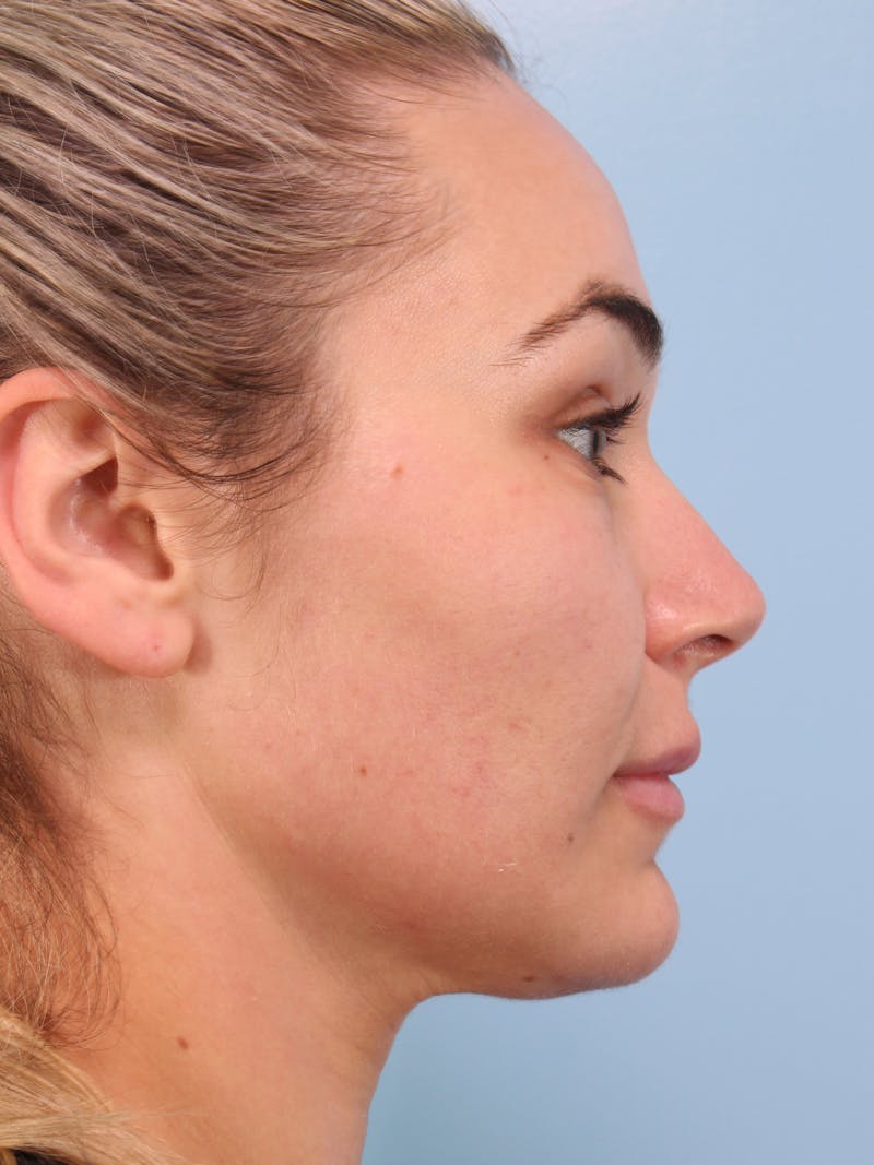 Thread Lift Before & After Gallery - Patient 228155 - Image 1